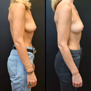 Breast lift before and after photo, side view