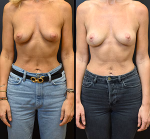 Breast lift before and after photo, front view