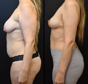 Breast lift before and after photo, side view