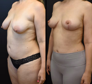 Breast lift before and after photo, front view