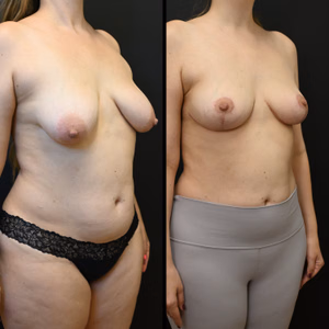 Breast lift before and after photo, front view