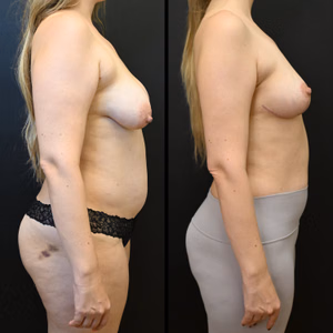 Breast lift before and after photo, side view