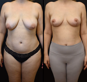 Breast lift before and after photo, front view