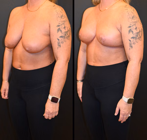 Breast lift before and after photo, front view