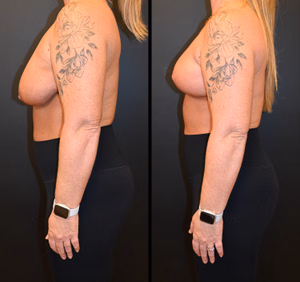 Breast lift before and after photo, side view