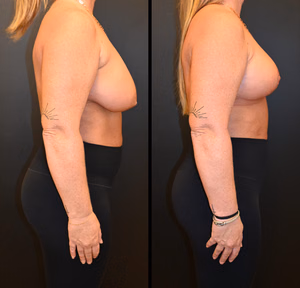 Breast lift before and after photo, side view