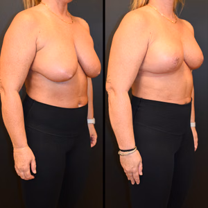 Breast lift before and after photo, front view