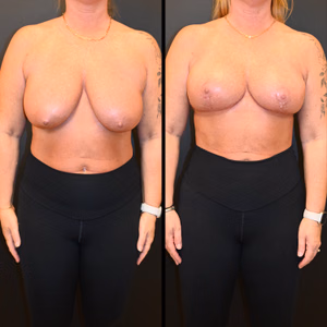 Breast lift before and after photo, front view