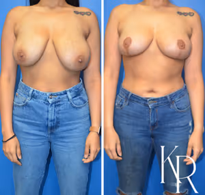 Breast lift before and after photo, front view