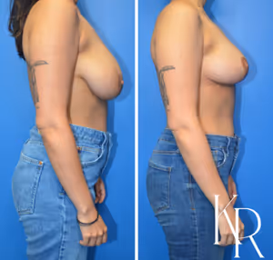 Breast lift before and after photo, side view