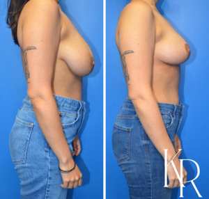 Breast lift before and after photo, side view