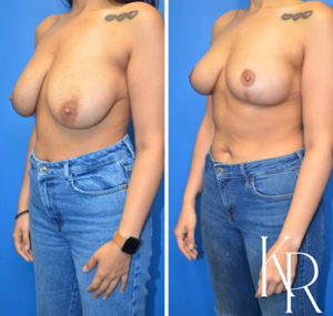Breast lift before and after photo, front view