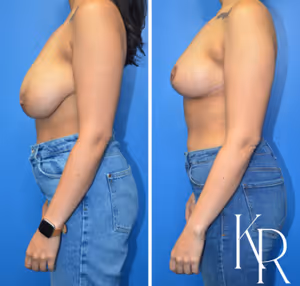 Breast lift before and after photo, side view