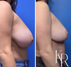 Breast lift before and after photo, side view