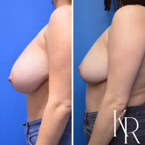 Breast lift before and after photo, side view