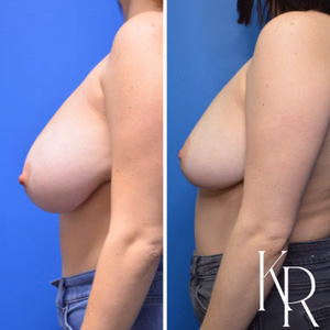 Breast lift before and after photo, side view
