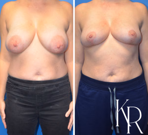 Breast lift before and after photo, front view