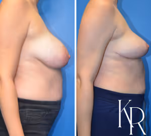 Breast lift before and after photo, side view