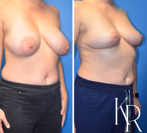 Breast lift before and after photo, front view