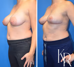 Breast lift before and after photo, front view