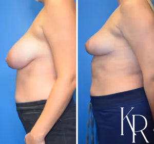 Breast lift before and after photo, side view