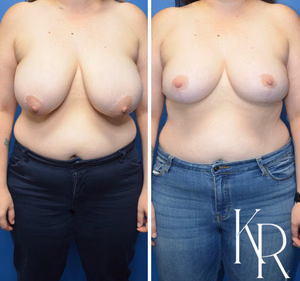 Breast lift before and after photo, front view