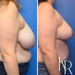 Breast lift before and after photo, side view