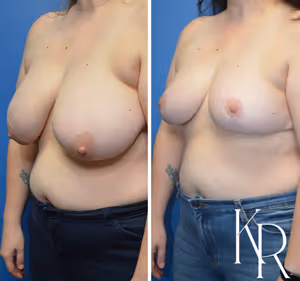 Breast lift before and after photo, front view