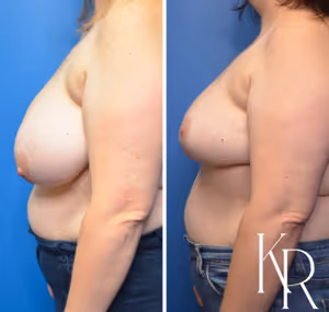 Breast lift before and after photo, side view