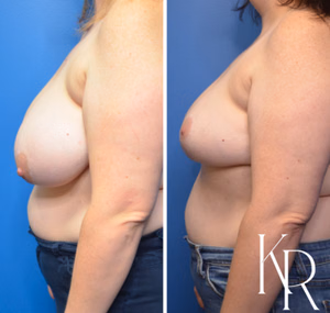 Breast lift before and after photo, side view