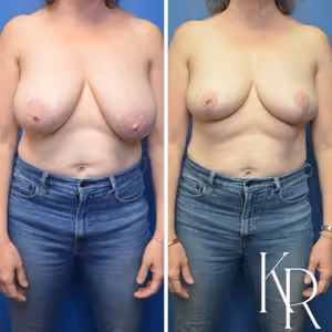 Breast lift before and after photo, front view