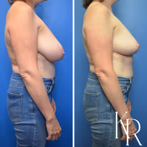 Breast lift before and after photo, side view