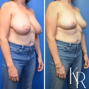 Breast lift before and after photo, front view