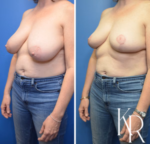 Breast lift before and after photo, front view