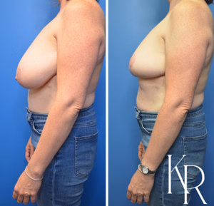 Breast lift before and after photo, side view