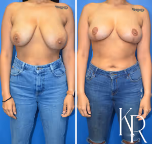 Breast reduction before and after photo, front view