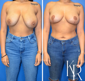 Breast reduction before and after photo, front view