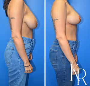 Breast reduction before and after photo, side view