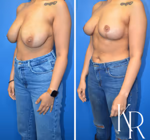 Breast reduction before and after photo, front view