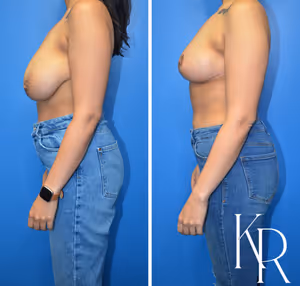 Breast reduction before and after photo, side view