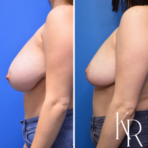 Breast reduction before and after photo, side view