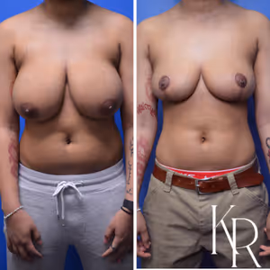 Breast reduction before and after photo, front view
