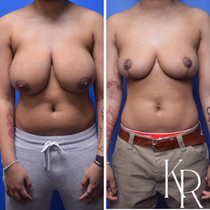 Breast reduction before and after photo, front view