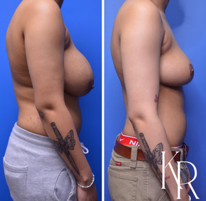 Breast reduction before and after photo, side view