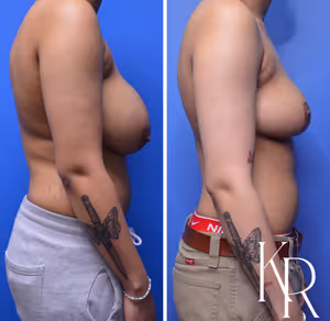 Breast reduction before and after photo, side view