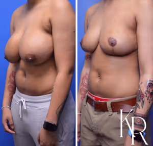 Breast reduction before and after photo, front view