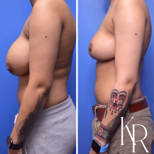 Breast reduction before and after photo, side view