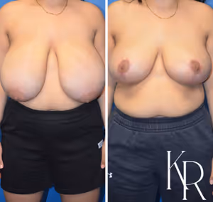 Breast reduction before and after photo, front view