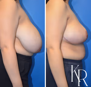 Breast reduction before and after photo, side view