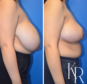 Breast reduction before and after photo, side view